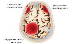 Внутримозговое кровоизлияние: лечение, причины, симптомы, признаки