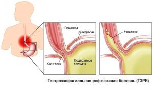 Гастроэзофагеальный рефлюкс (ГЭР) у детей: симптомы, лечение, причины, признаки