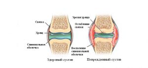 Сустав как комплексная многокомпонентная система