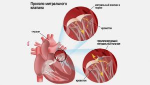 Митральная регургитация: степени, лечение, симптомы, признаки, причины