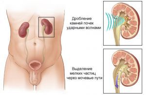 Почечнокаменная болезнь, лечение, симптомы