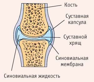 Костные компоненты сустава