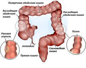 Рак ободочной кишки: симптомы, стадии, прогноз, лечение, признаки, причины