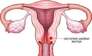 Эктопия шейки матки: лечение, признаки, прогноз, причины, симптомы
